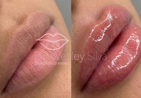 preencimento_labial_portoalegre preencimento_labial_portoalegre