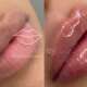 preencimento_labial_portoalegre