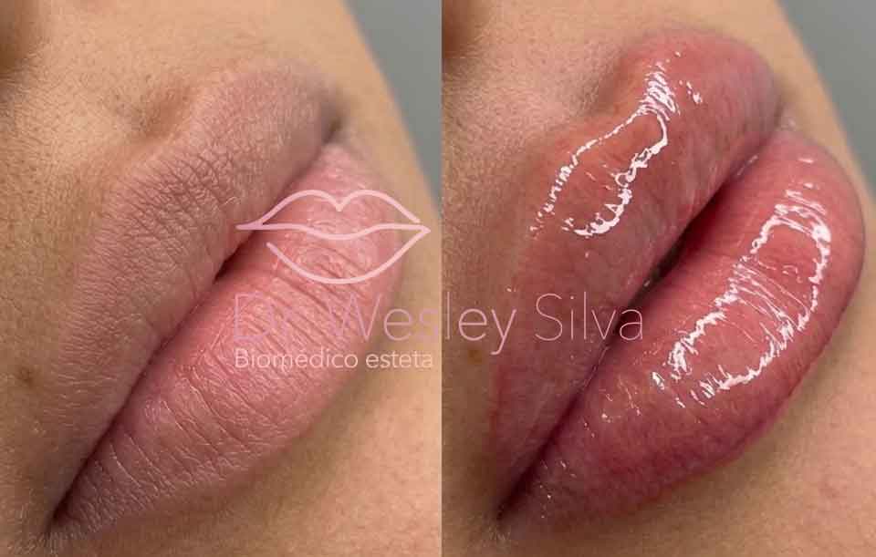 preencimento_labial_portoalegre